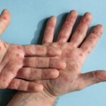 Wabah Campak di Bangkalan Serang Ratusan Balita, 1 Anak Meninggal Dunia