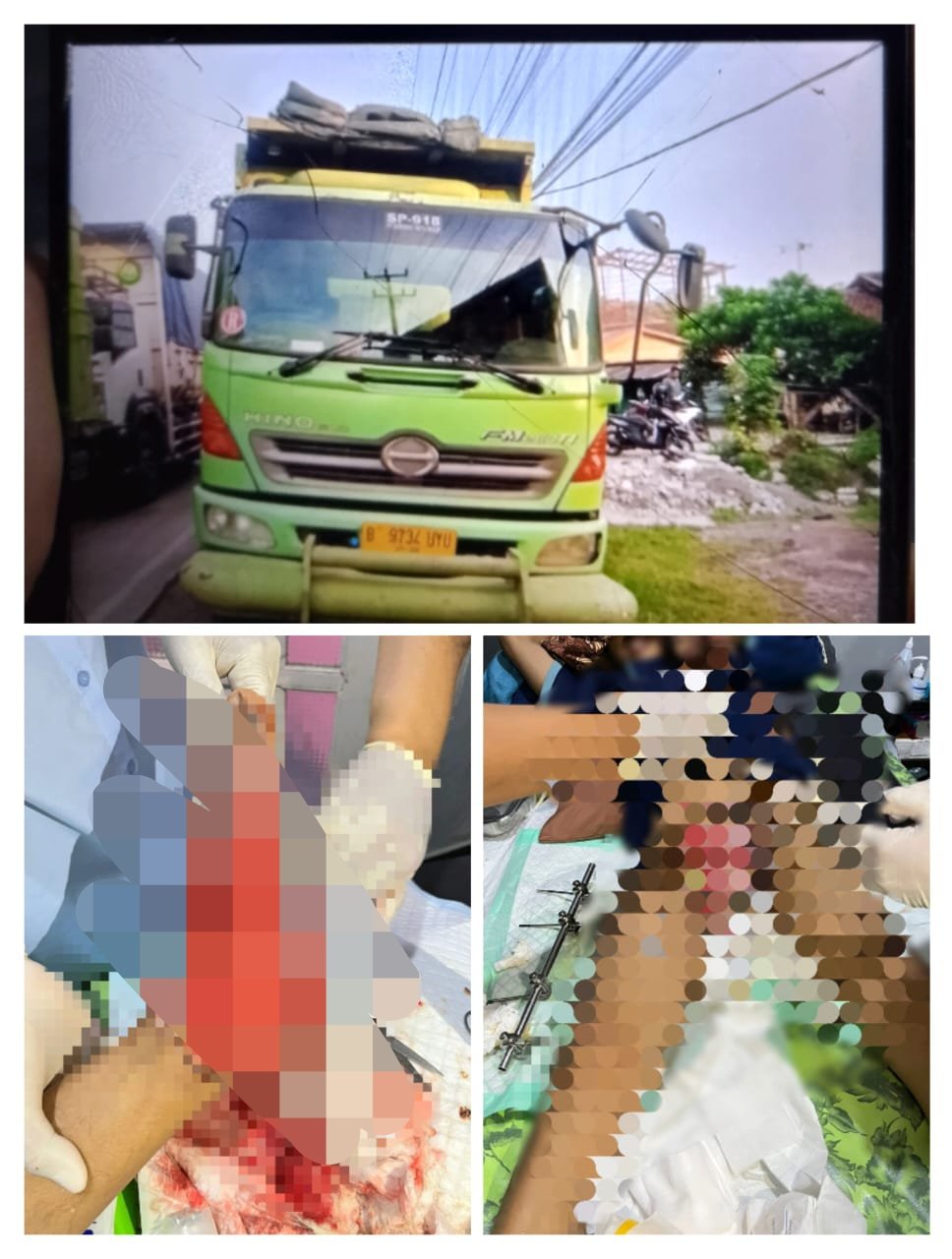 Korban Kecelakaan Beruntun di By Pass Panjang Alami Luka Parah, Keluarga Benny Desak Tanggung Jawab Hukum